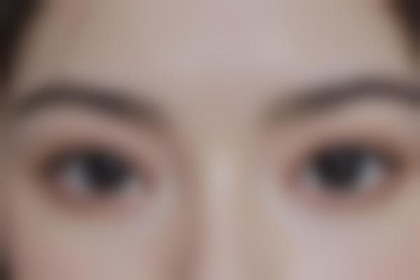 双眼皮手术吗？医生手术过程和术后护理重点