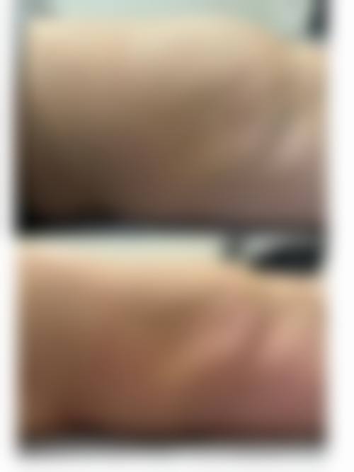 飞顿黄金热拉提2.0和热拉提plus的区别在哪？从治疗深度、效果维持时长等5大方面为你揭秘！ 