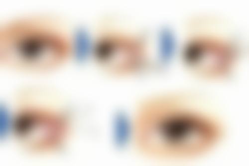 倍舒痕祛疤膏修复中重度增生性手术疤痕值不值？