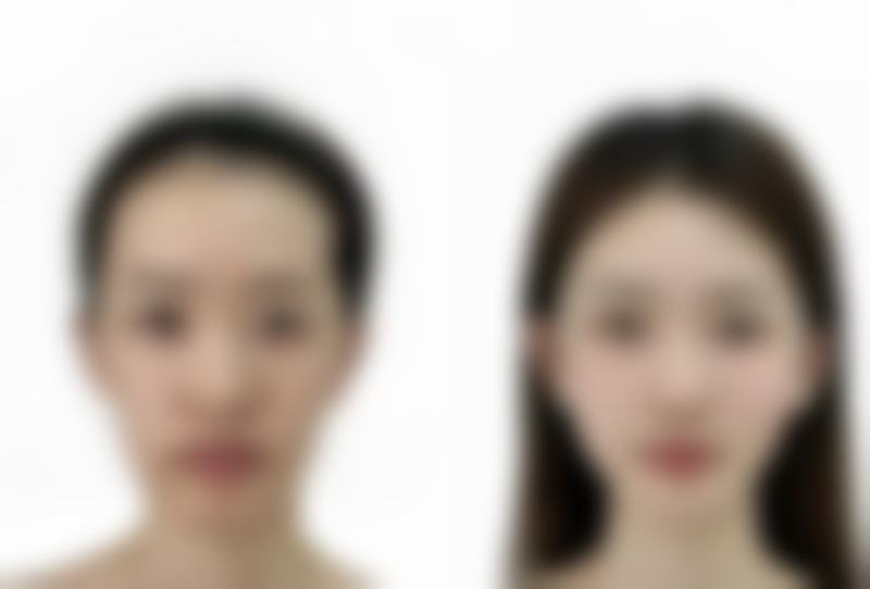 泉州海峡医疗美容门诊部祛色素疤痕值不值