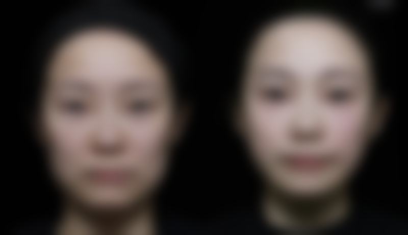 康瑞保复方肝素钠尿囊素凝胶用于手术疤痕综合修护靠谱吗？