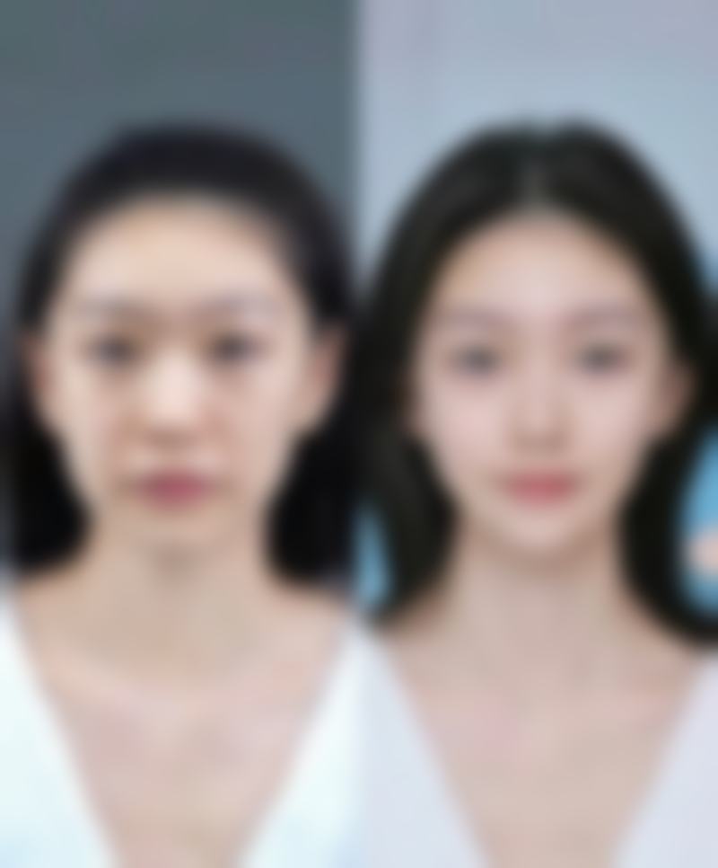 打完瘦脸针脸变大了多久能修复正常