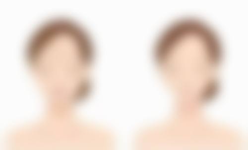 耳软骨隆鼻尖能一辈子吗？揭秘3大关键因素，了解如何让效果持久，为你打造终身美鼻不是梦！ 