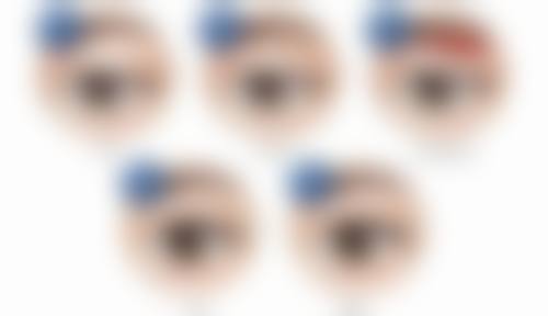 西安莲湖西交疤痕医院去除手术增生的疤痕适合吗