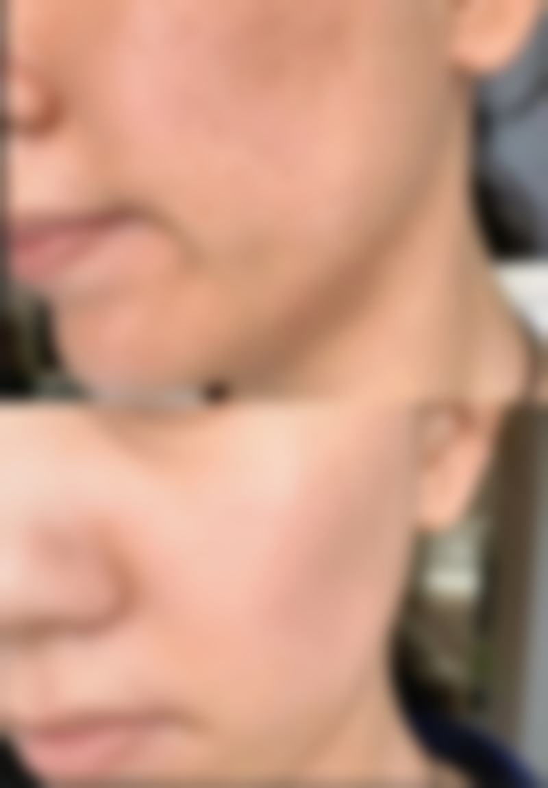 西安莲湖西交疤痕去除脸上痘印疤痕成效怎么样