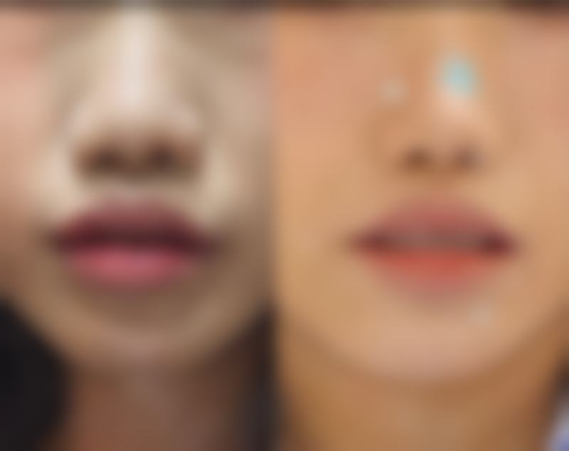 北京圣嘉新医疗美容医院：双眼皮3个月修复成效怎么样？