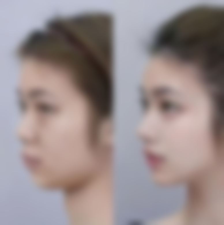 北京画美医疗美容医院耳软骨隆鼻尖适合追求终身美鼻的人吗？