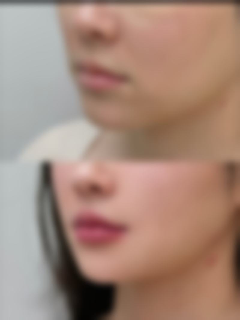 北京圣嘉新医疗美容医院膨体隆鼻靠谱吗？