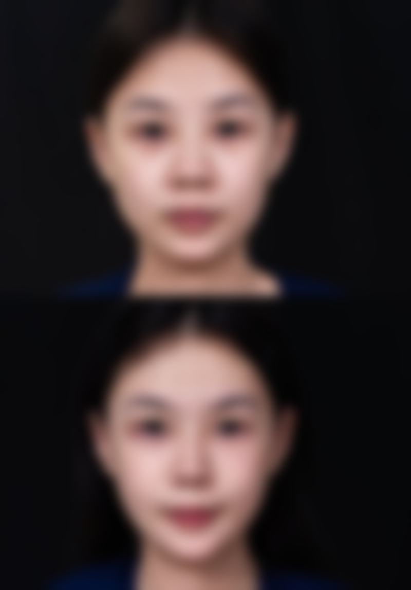 日常护理对去除脸上痘印疤痕有多重要