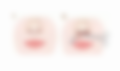 镇江徐斌割双眼皮后喝咖啡适合吗？