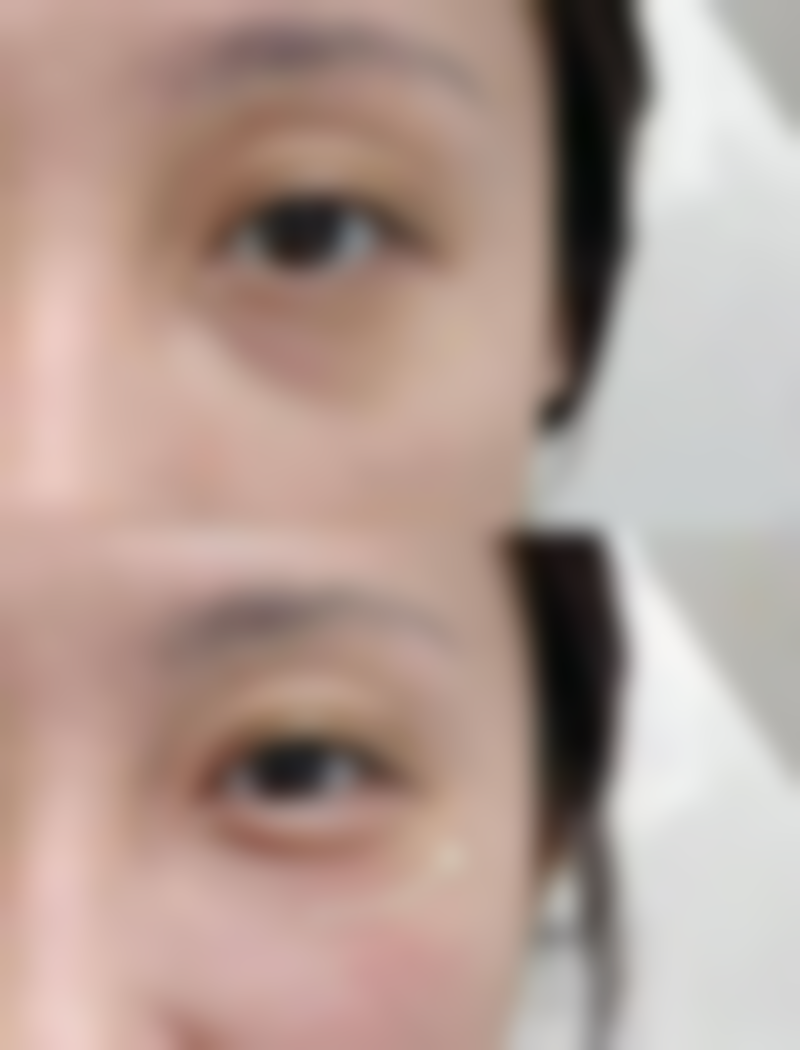 成都军建医院去除疤痕上的色素适合所有人吗？