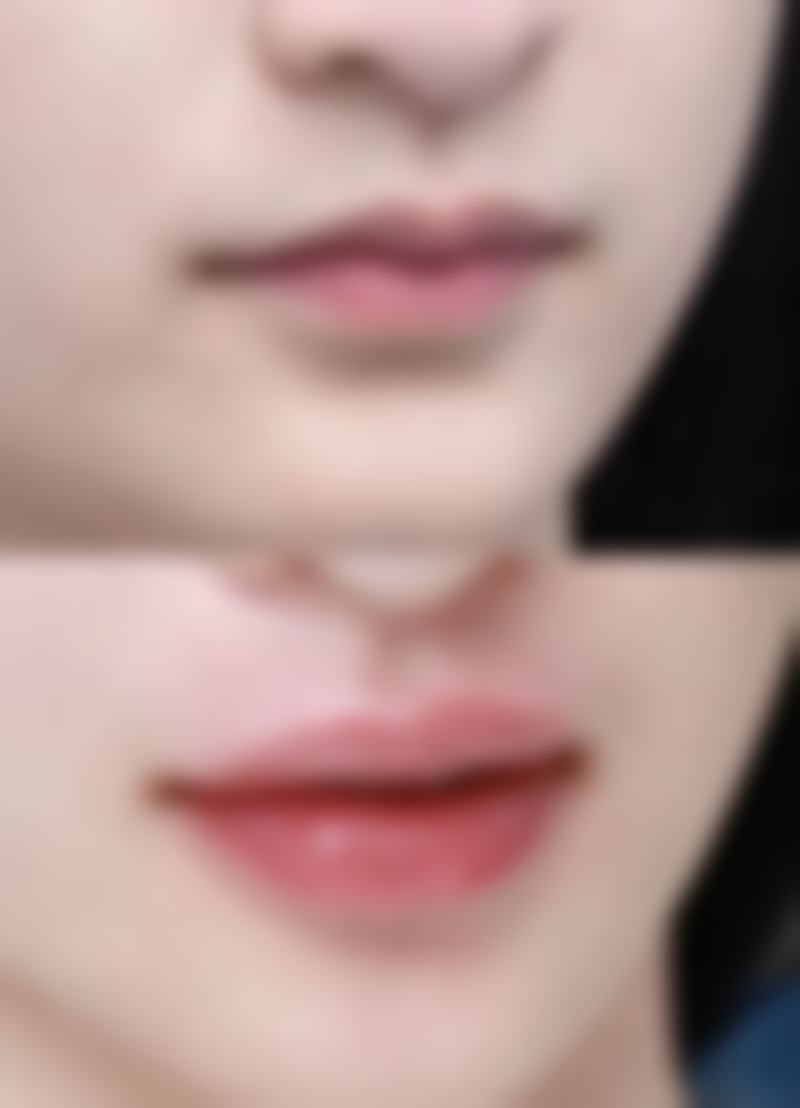 北京嘉禾医疗美容全切双眼皮第八天拆线靠谱吗