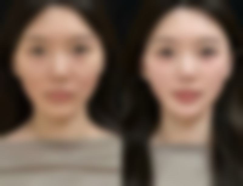 北京圣嘉新医疗美容医院全切双眼皮第八天拆线适合吗