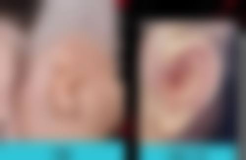 广州美莱医疗美容整形医院打瘦脸针后咀嚼无力正常吗