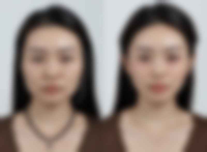 北京嘉禾医疗美容割双眼皮修复快吗？