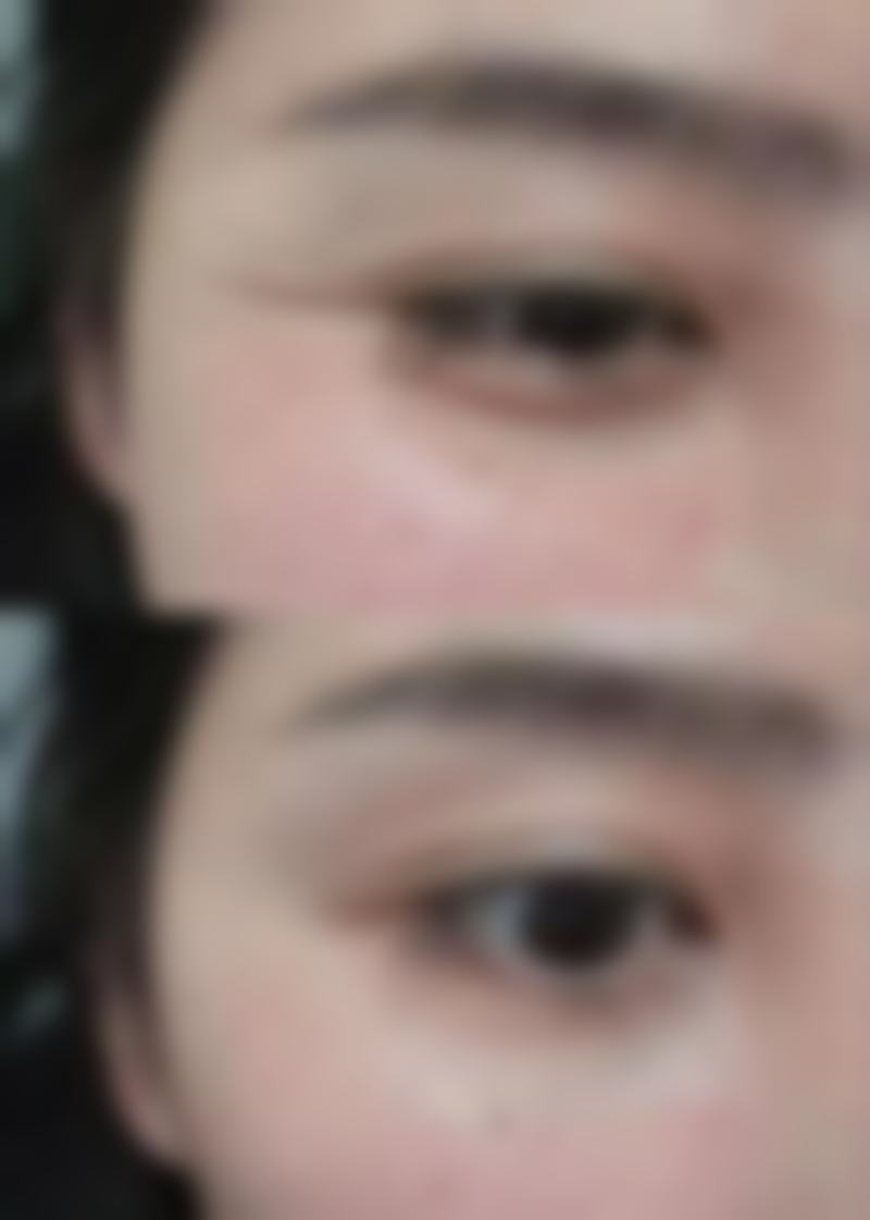 沈阳杏林整形医院割眼袋技术适合我吗？