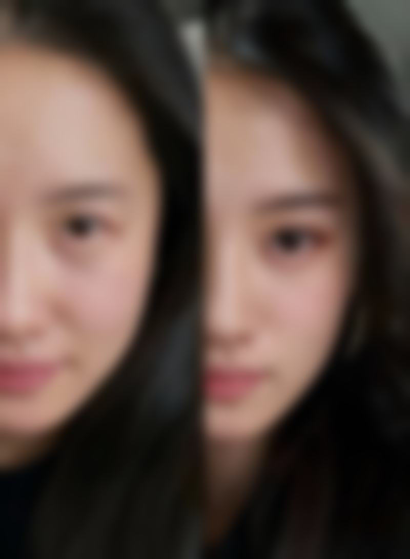 呼和浩特京美医疗美容医院埋线法双眼皮成效靠谱吗