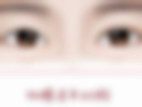 武科 大附属紫荆医院医疗美容科埋线双眼皮修复原来样子成功几率如何？