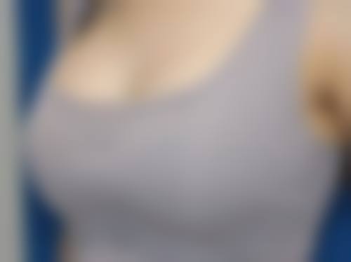 沈阳杏林整形外科医院双下巴吸脂增生期肿胀情况怎么样？