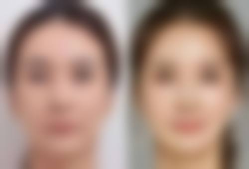 呼和浩特京美医疗美容做去眼袋手术，生理期做值不值