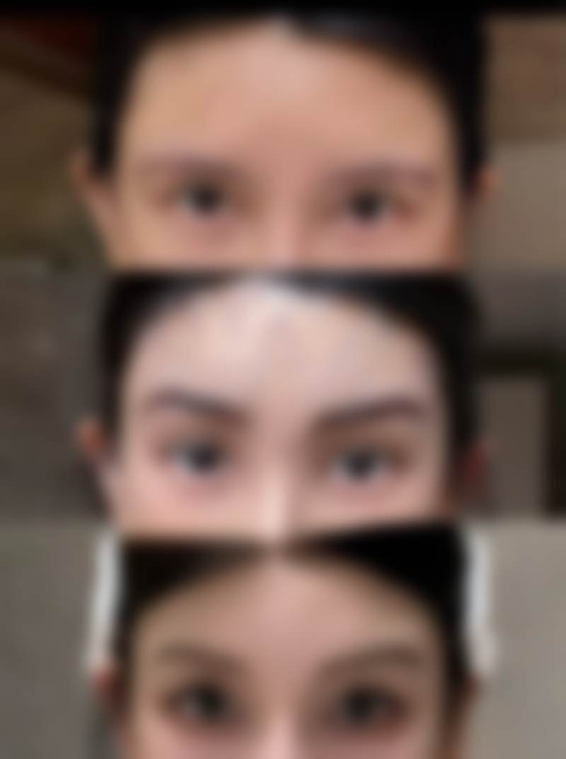 蜜桃隆胸假体在中美合资医院性价比高吗？