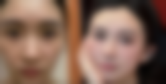 沈阳杏林整形外科医院双眼皮埋线线断裂几率大吗？