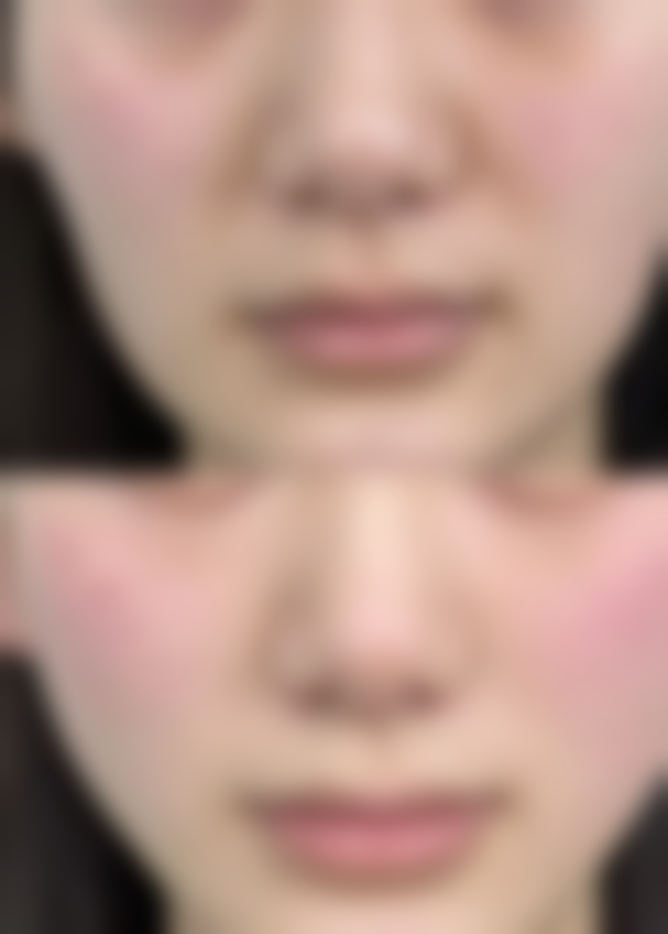 北京丽合医疗美容治疗疤痕增生多久可以软化适合吗