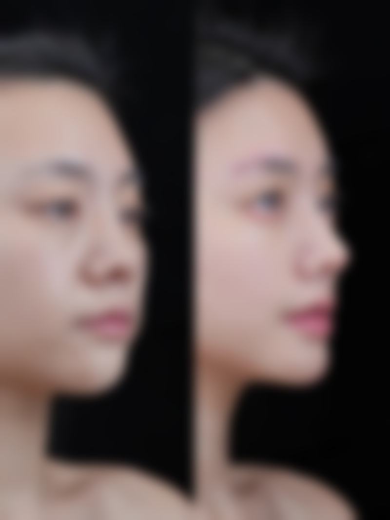 沈阳杏林整形埋线双眼皮修复自然怎么样？