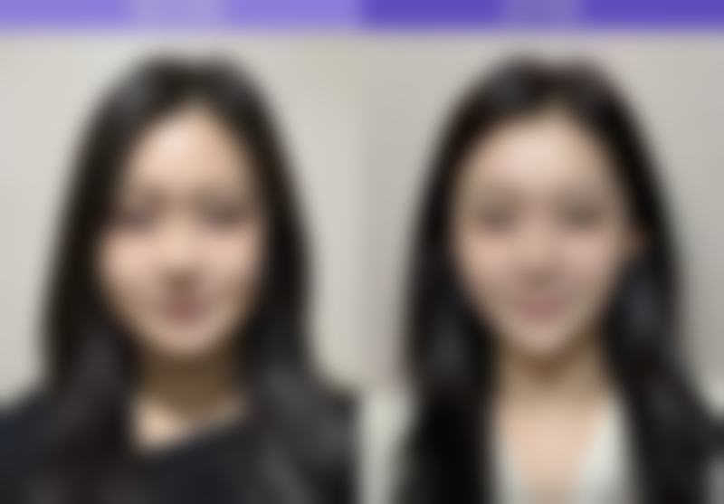 北京嘉禾医疗美容双眼皮手术靠谱吗，会导致显老吗？