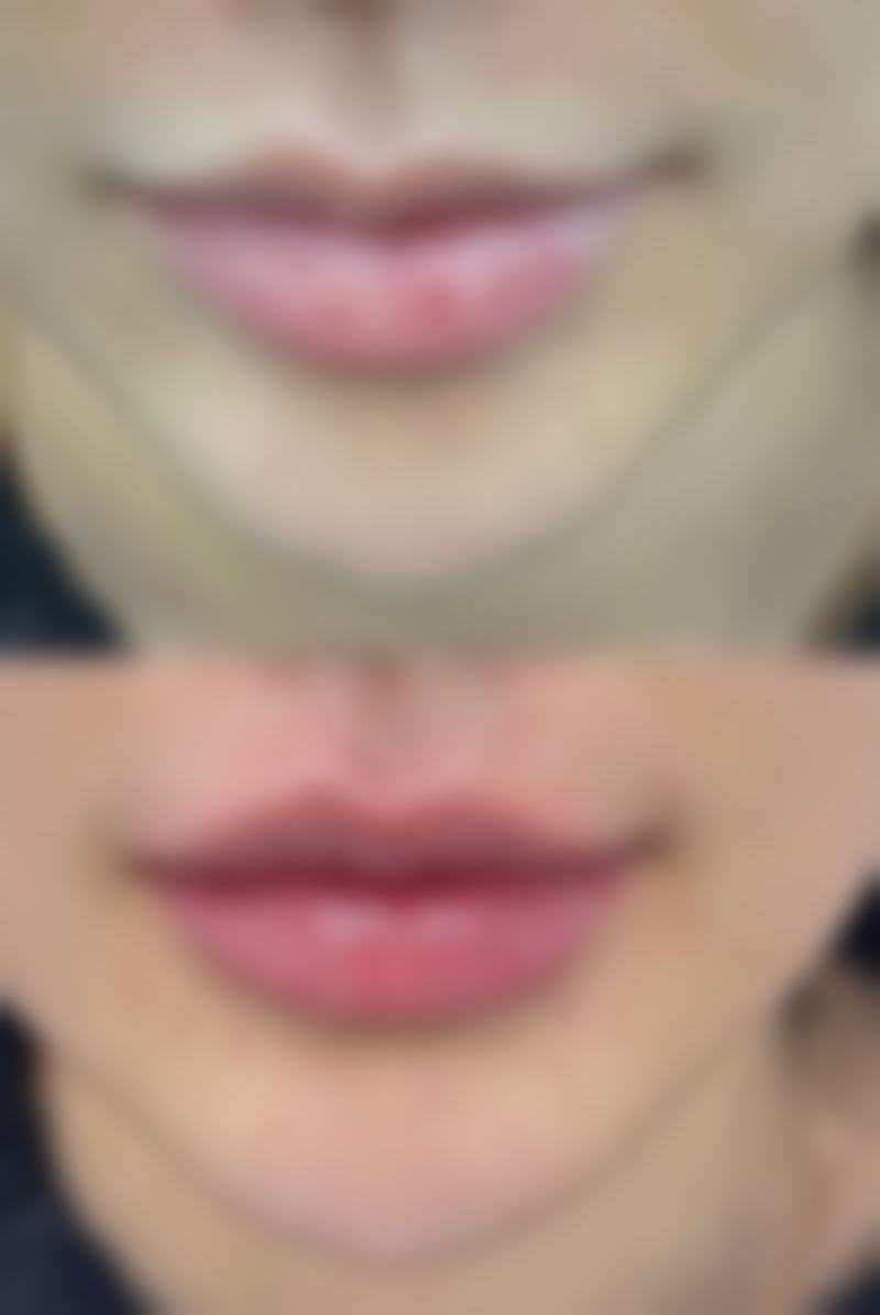 双眼皮埋线线会不会断？深度剖析埋线断裂几率、影响因素及有效预防方法，让你安心变美！ 