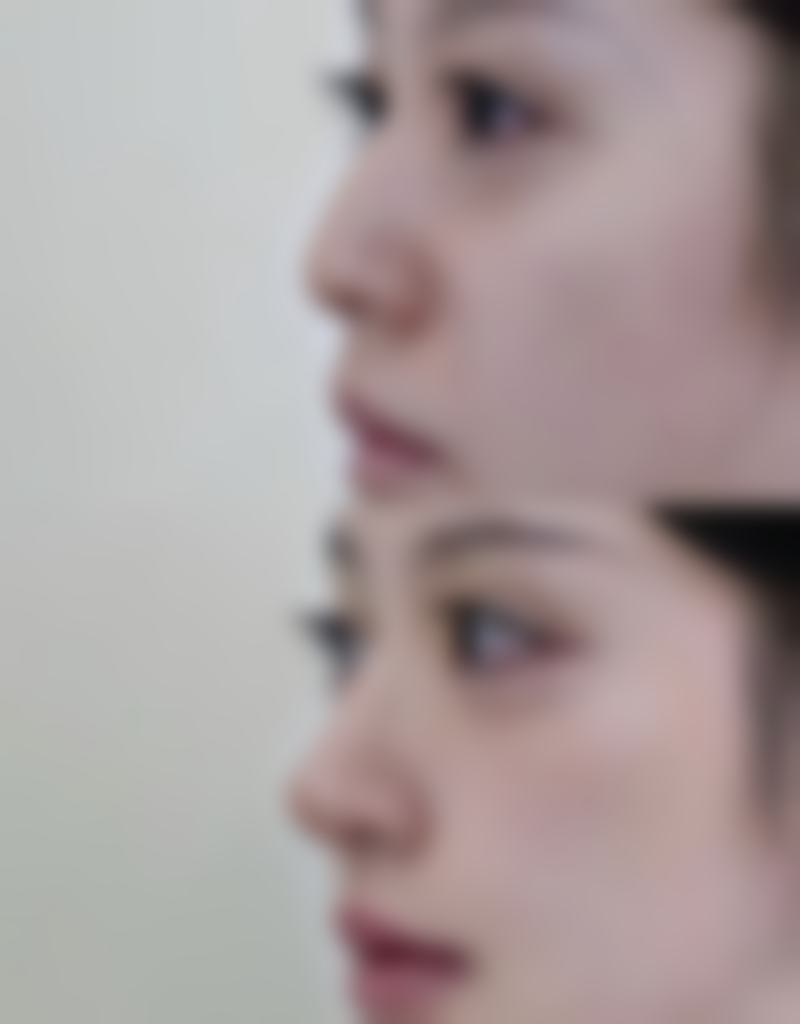 沧州蓝途整形医院真实实例