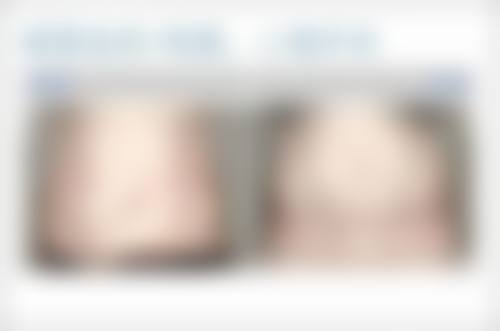 沈阳美莱医疗美容医院耳软骨隆鼻住院情况怎么样？