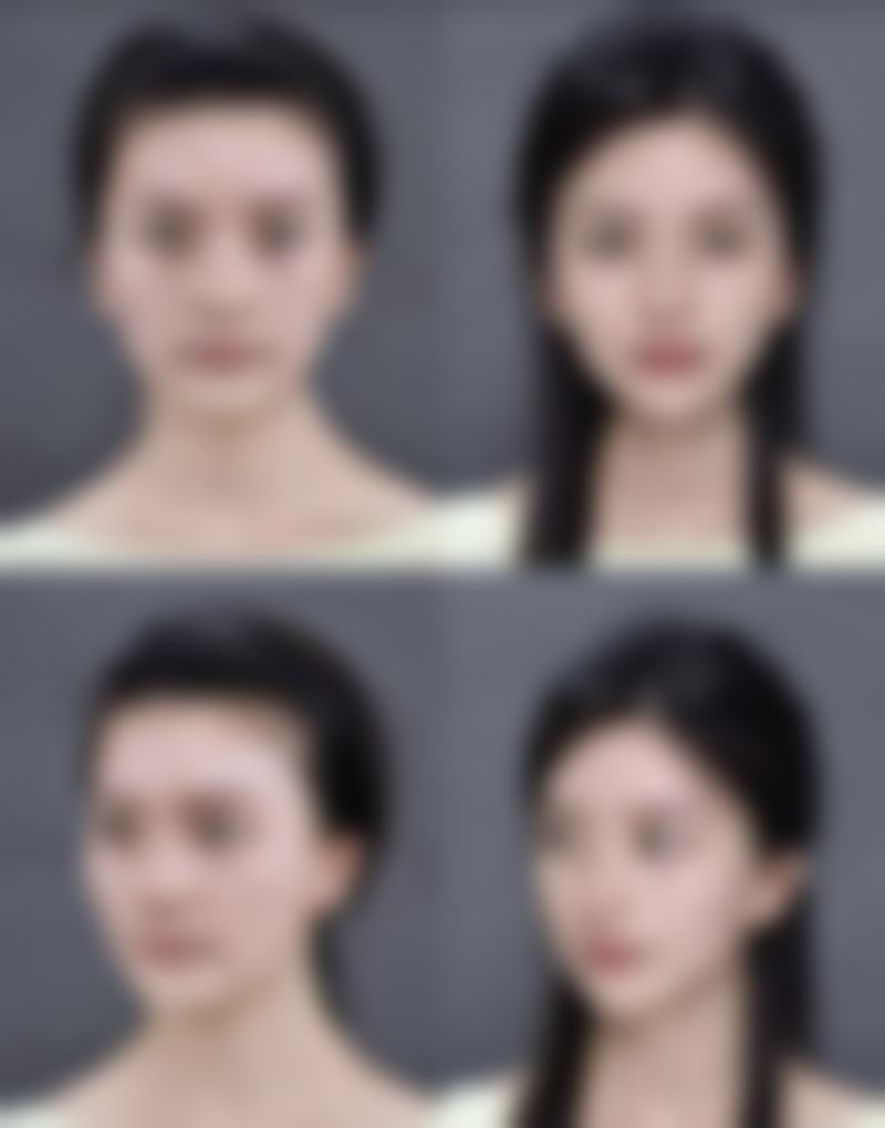 外切眼袋脂肪去多了怎么办？揭秘3大修复方法，告别眼部凹陷，28天让你重焕明亮双眸！ 