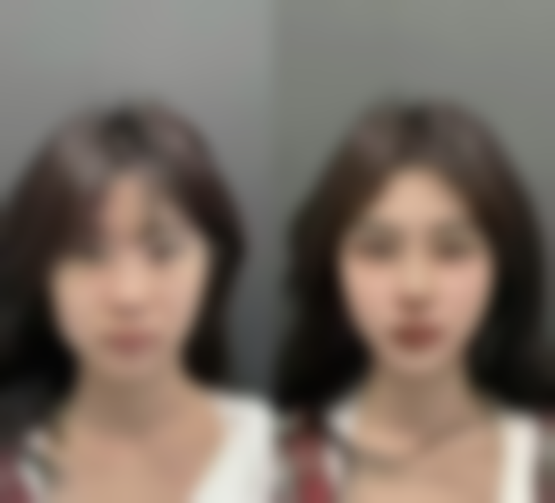 北京嘉禾医疗美容，面部咬肌突出脸适合打瘦脸针吗？