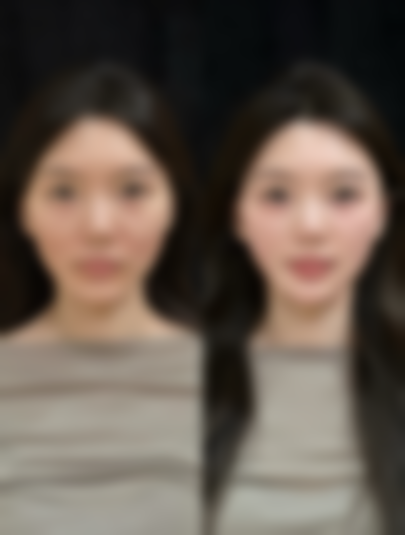 北京圣嘉新医疗美容医院，因咬肌导致的宽脸适合打瘦脸针吗？