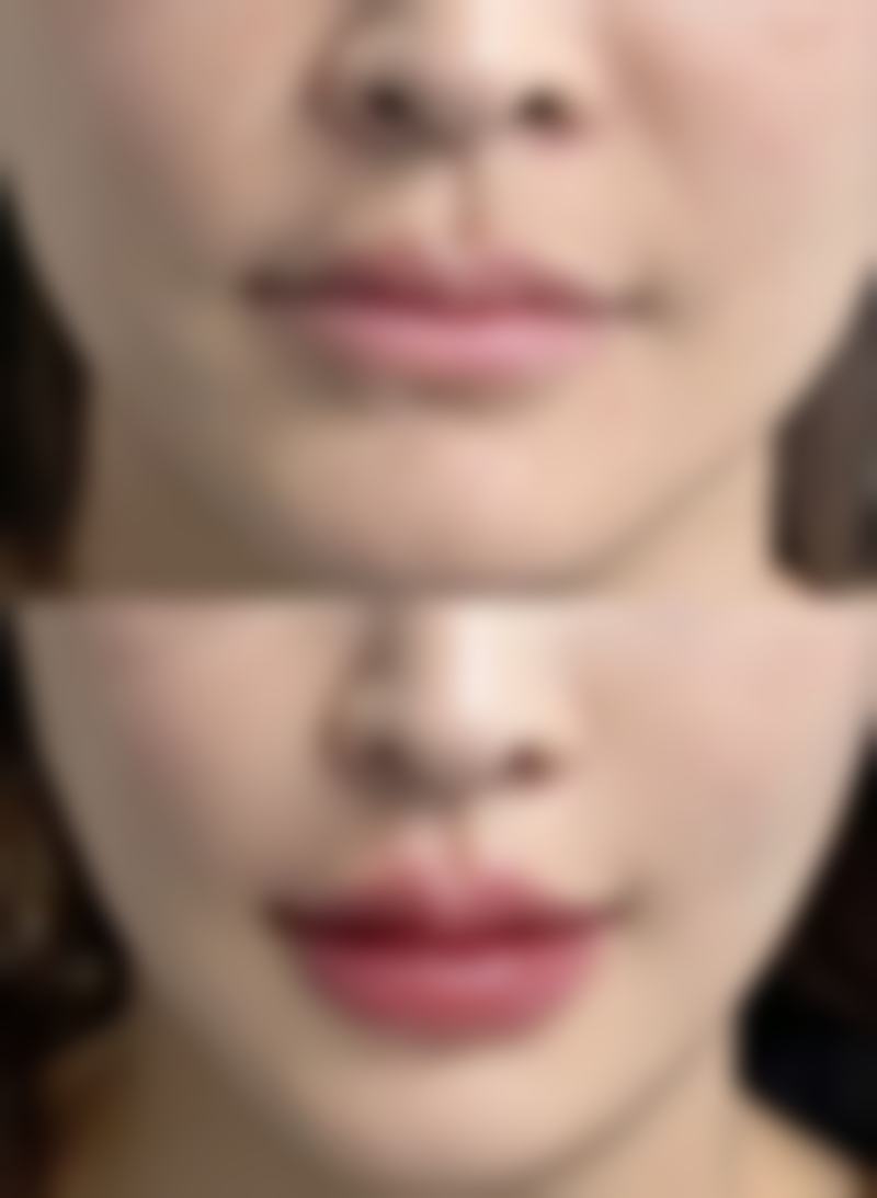 西安画美整形医院自体耳软骨隆鼻修复速度值不值选择？