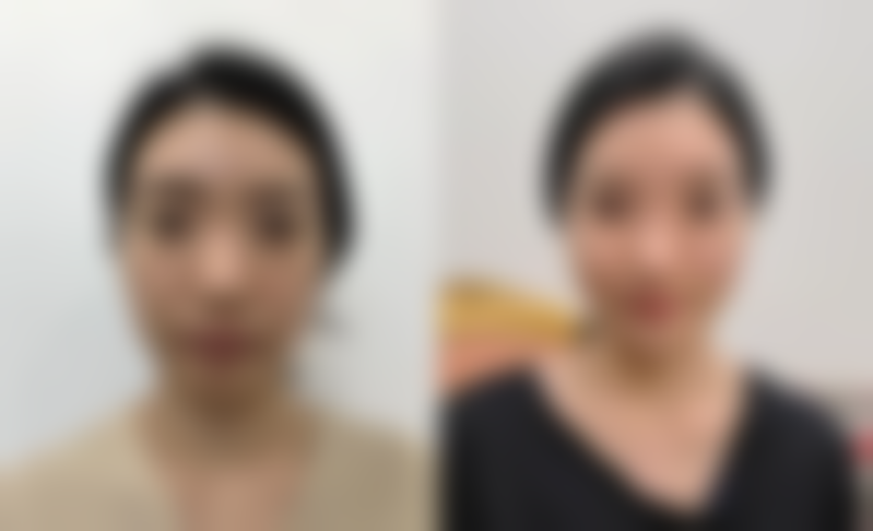 自体耳软骨隆鼻多久恢复？了解术后3大恢复阶段时间节点，掌握5个加速恢复秘诀！ 