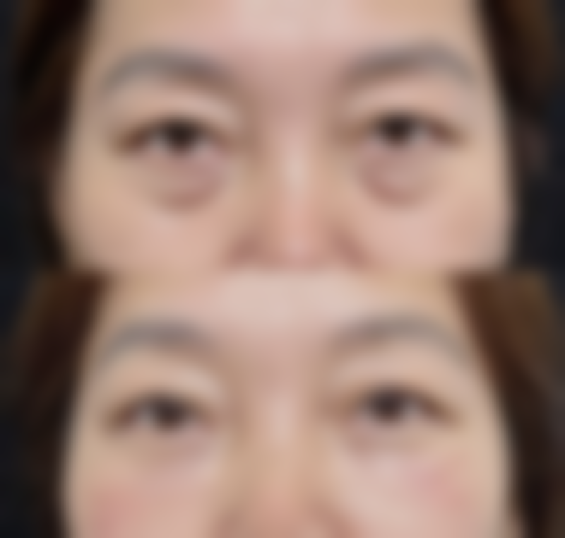 沈阳北方整形医院耳软骨隆鼻住院值不值？