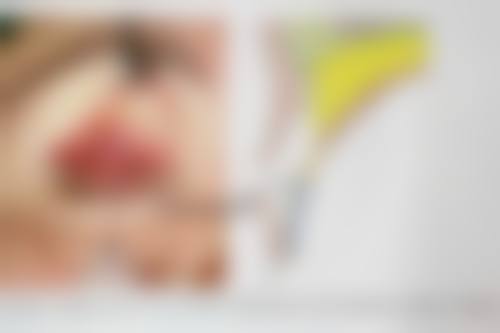 北京圣嘉新医疗美容医院割双眼皮后期有啥副作用？