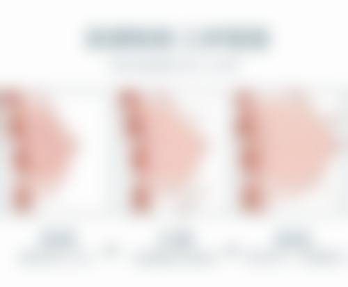 沈阳杏林整形外科医院割双眼皮后期副作用大吗？