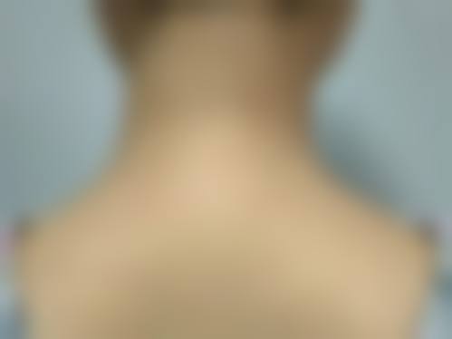 惠阳三和整形医院真实实例：见证美丽蜕变