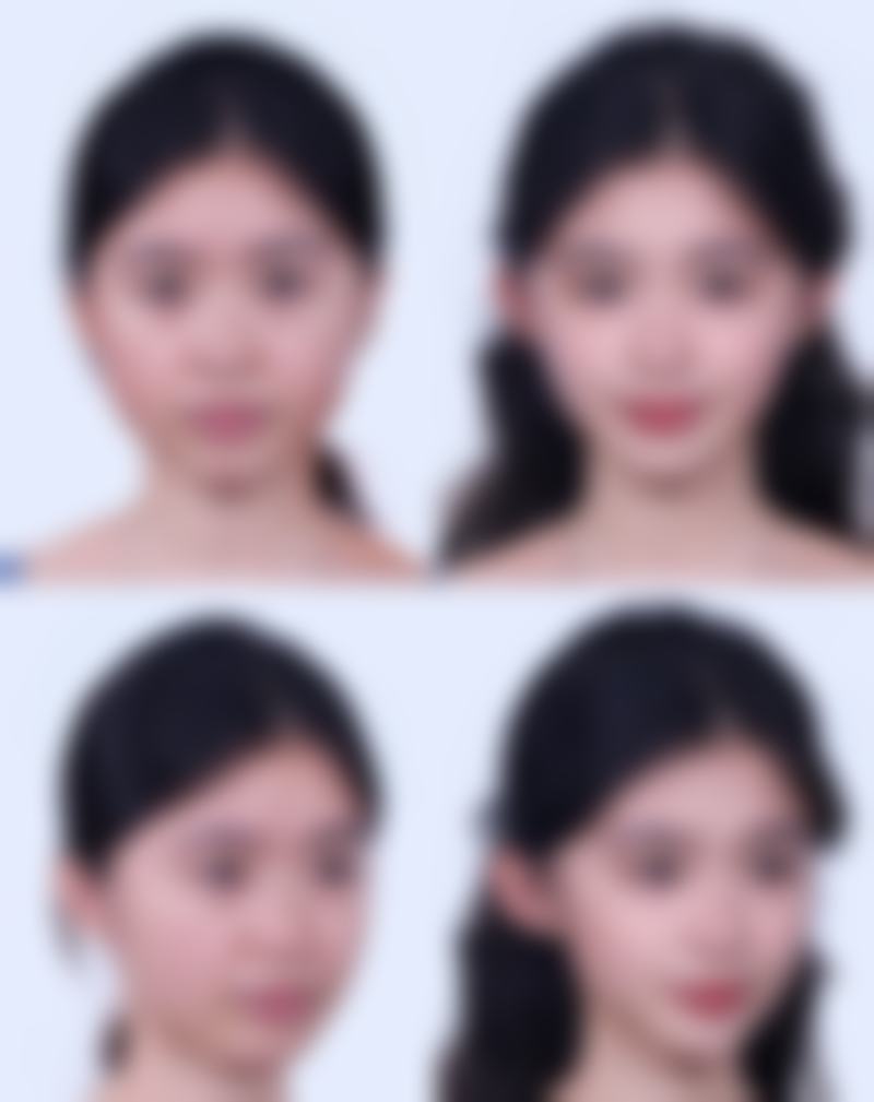 非常爱美网推荐的医美消除眼袋项目适合有眼袋的人吗？