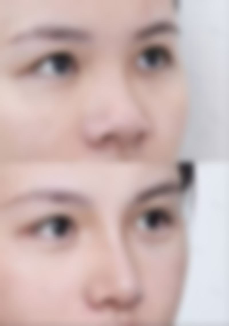 隆胸一般多久恢复？看完这3大关键恢复期及促进恢复的5个实用妙招，让你快速重回美丽巅峰！ 