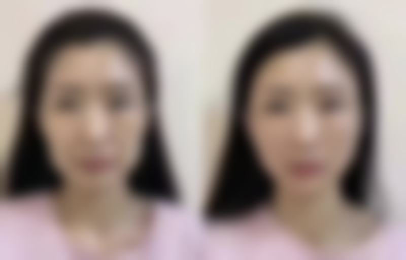 内吸去眼袋后淤青多久？了解 7 天恢复规律+5 大加速消退妙招，让你快速告别熊猫眼！ 