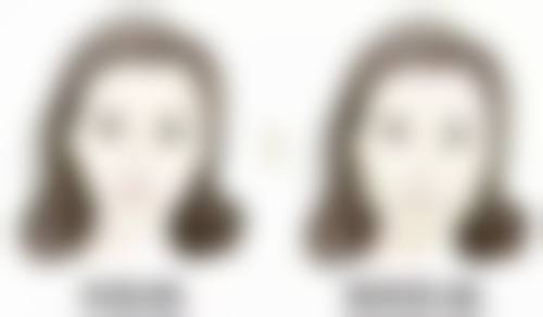 辽宁省人民医院整形外科提眉和双眼皮先做哪个适合吗？