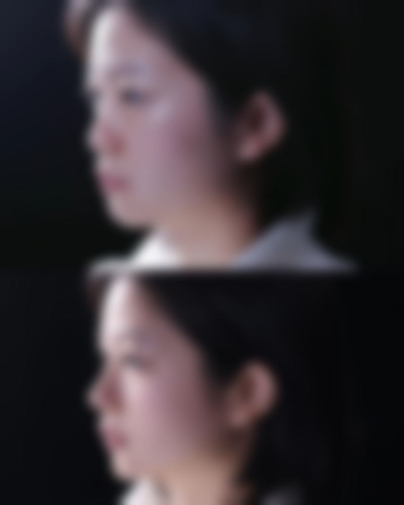 提眉和双眼皮哪个先做？专业解析手术顺序利弊，掌握3大要点让你变美少走弯路！ 