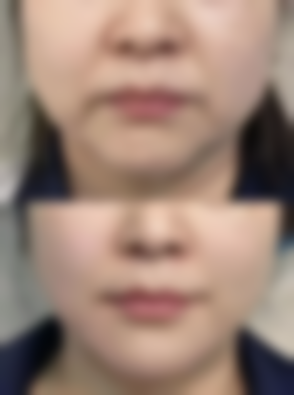 北京禾美嘉医疗美容的脂肪隆胸靠谱吗?