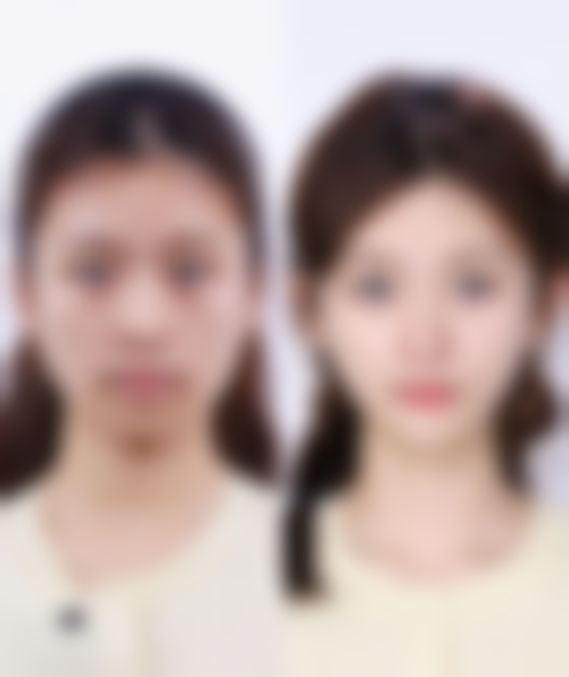 武科 大附属紫荆医院双眼皮割窄了加宽修复靠谱吗