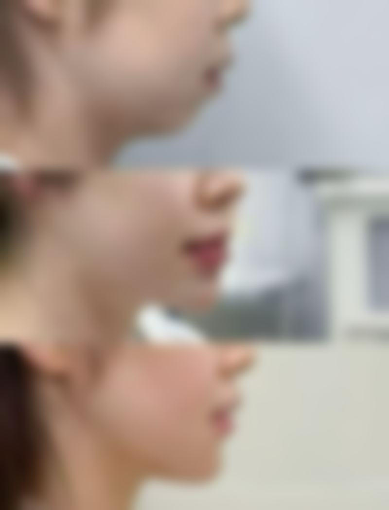 脂肪隆胸有什么危害吗？深度剖析3大潜在风险，揭秘降低危害的5个实用方法，让你安心变美！ 