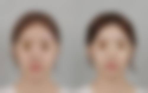 疤痕妊娠人流手术选择基层医院还是三等甲医院更适合？